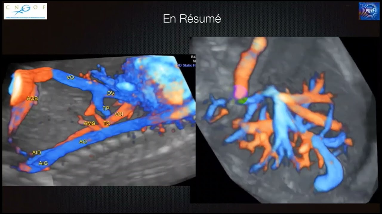 Vascularisation hepatique foetale JEAN PHILIPPE BAULT