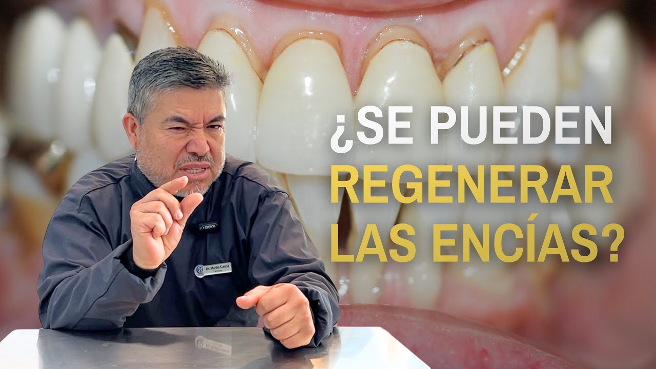 ¿Se puede recuperar la encía perdida? - Dr. Martín García 