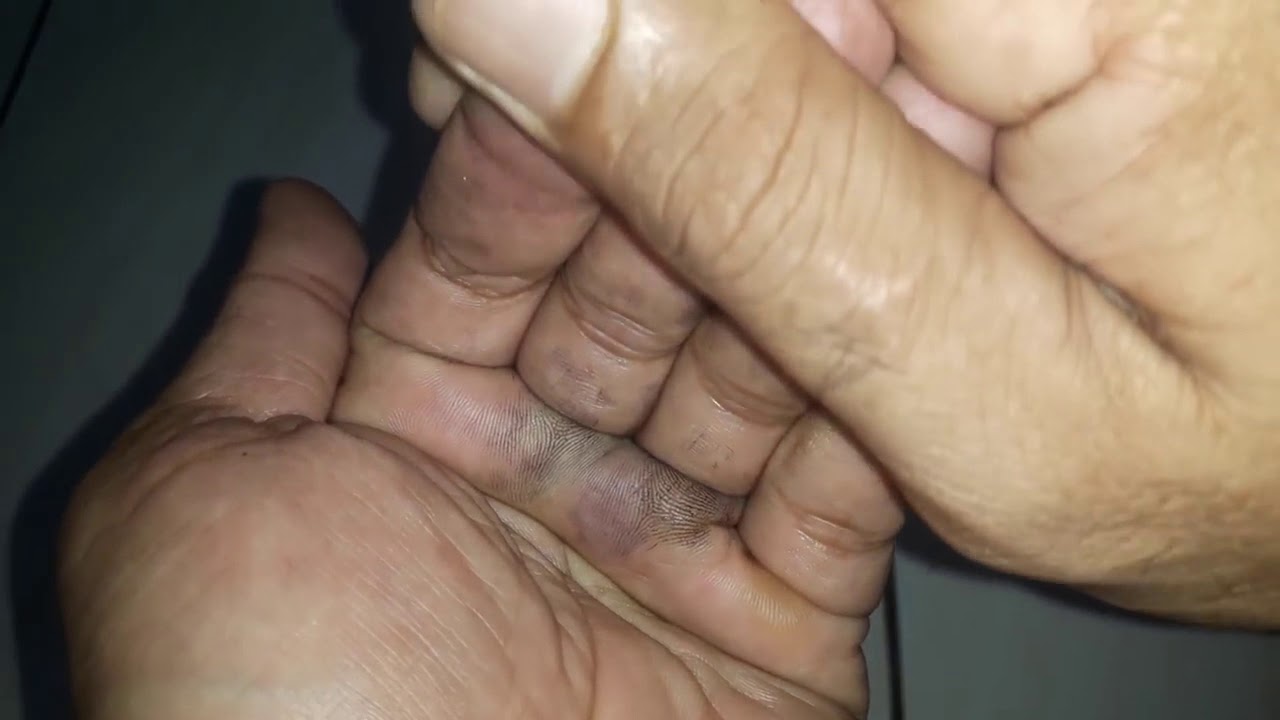 Tips atasi tangan yang tidak bisa bergerak karena bengkak