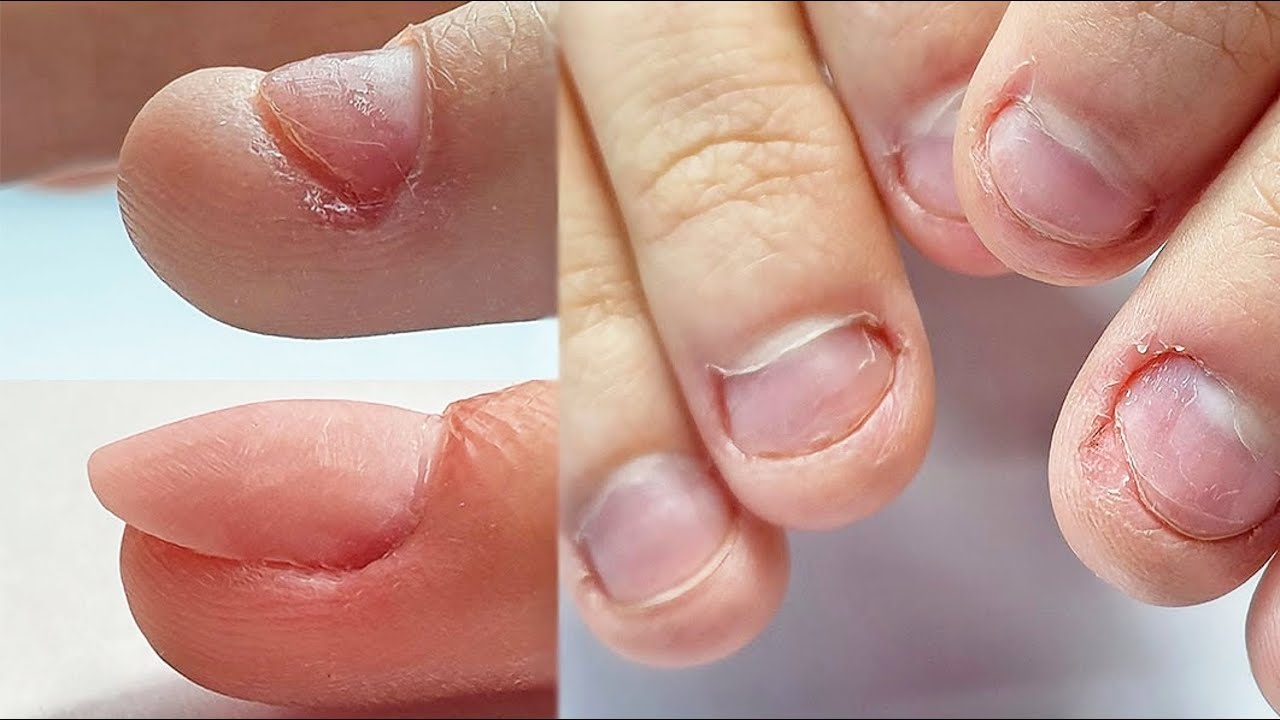 Cómo dejar de morderse las uñas? Manicura - de uñas mordidas a uñas hermosas