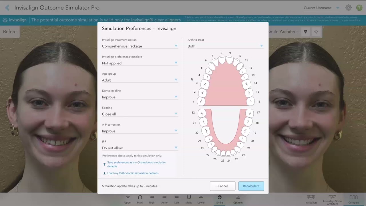 Invisalign&reg; Outcome Simulator Pro   设置偏好设置 IPP、IPR 和 AP 修正
