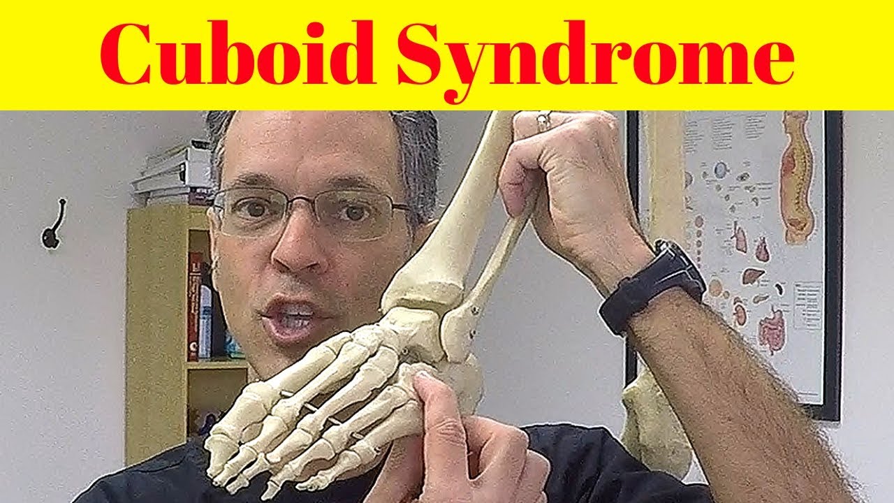 Cuboid Syndrome: Mysterious Foot Pain