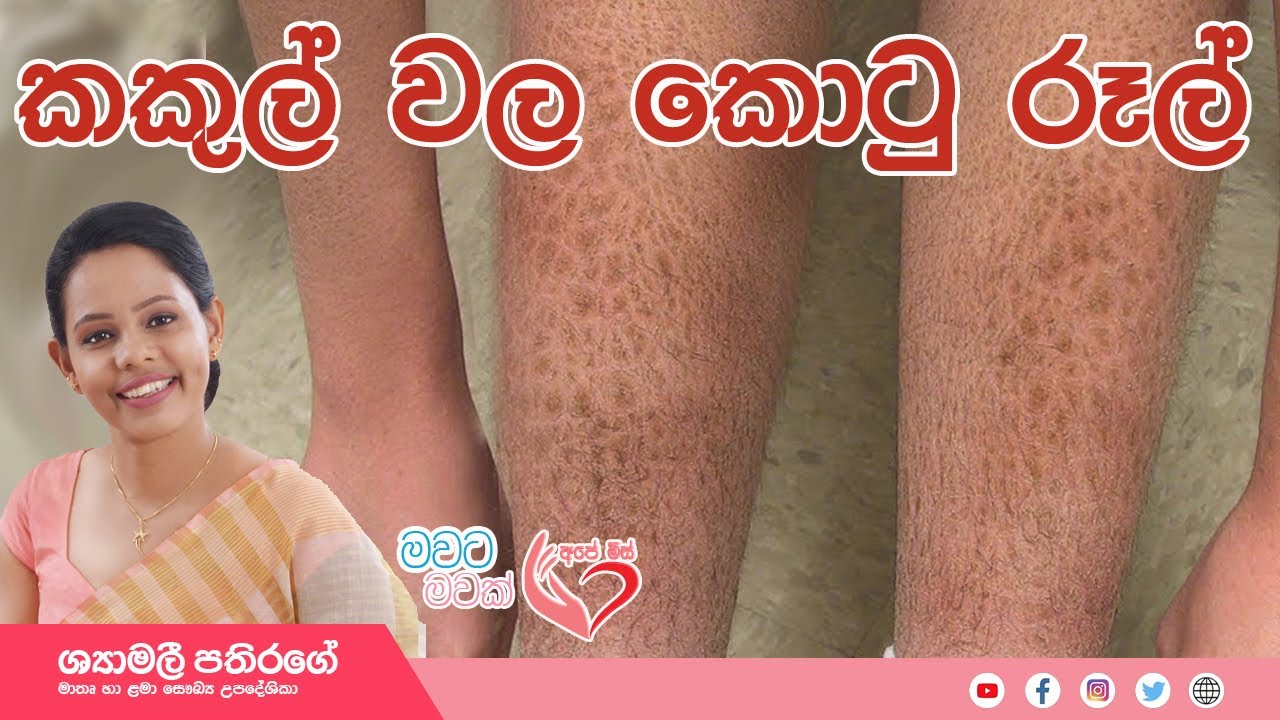 Ape Miss - දරුවන්ගේ කොරළ සම හෙවත්  වියලි සමට (Dry Skin) ප්‍රතිකර්මය | Shyamalee Pathirage