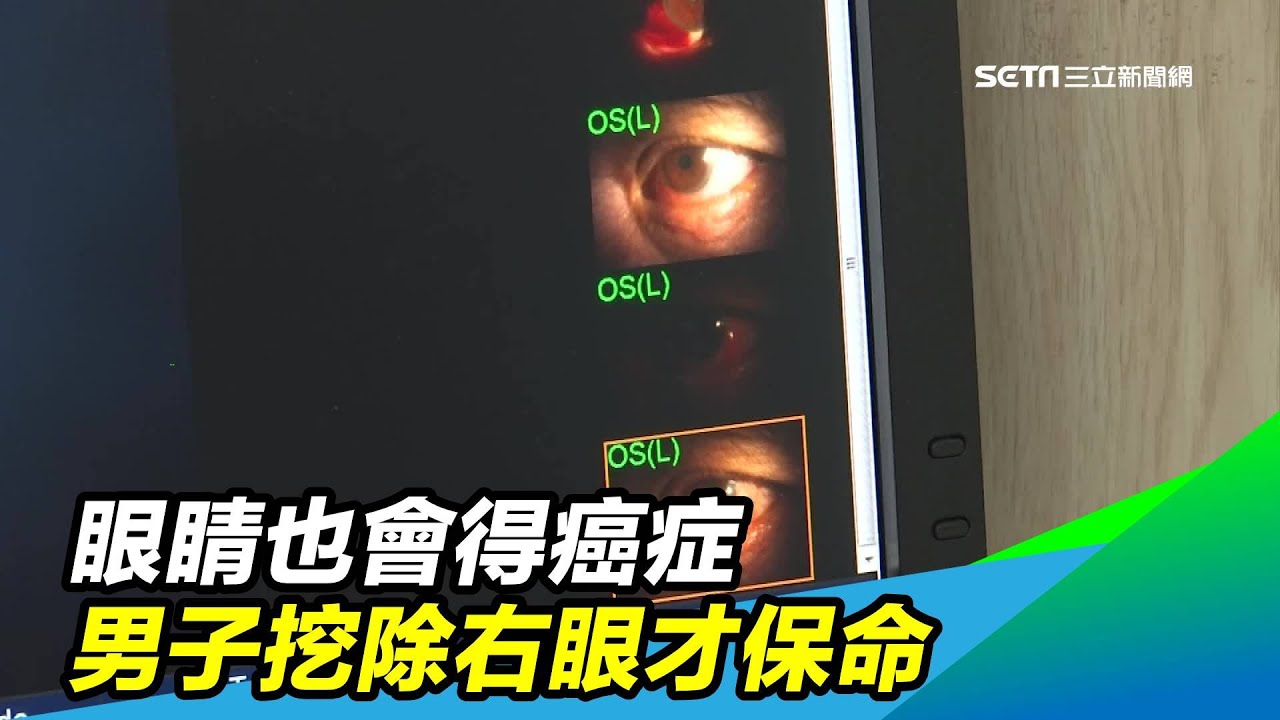 眼睛也會得癌症　男子挖除右眼才保命｜三立新聞台