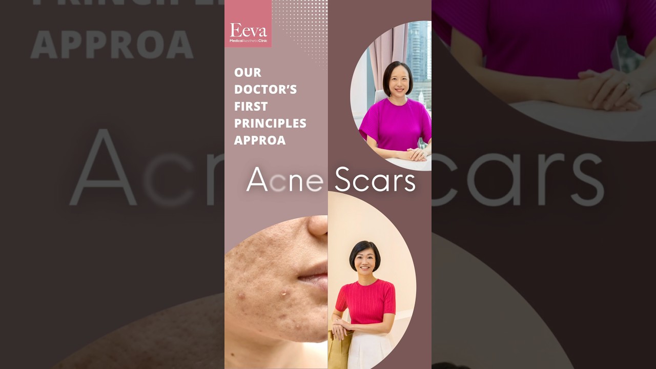Our doctors’ first principles approach on Acne Scars