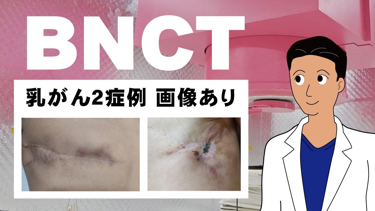 乳がん２症例（画像あり）　BNCT治療のＱＯＬと根治　江戸川病院でBNCT開始【概要欄へ】　#BNCT #乳がん