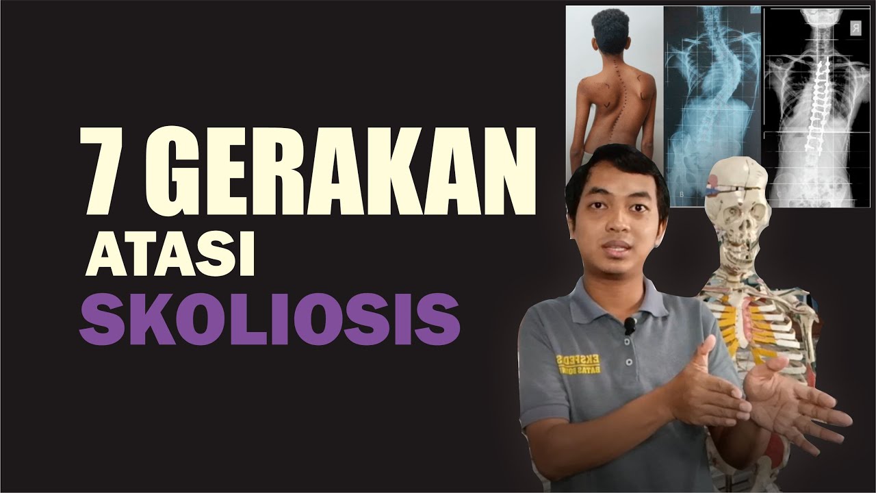 Latihan Untuk MENGATASI SKOLIOSIS, Bisa Dilakukan Dirumah