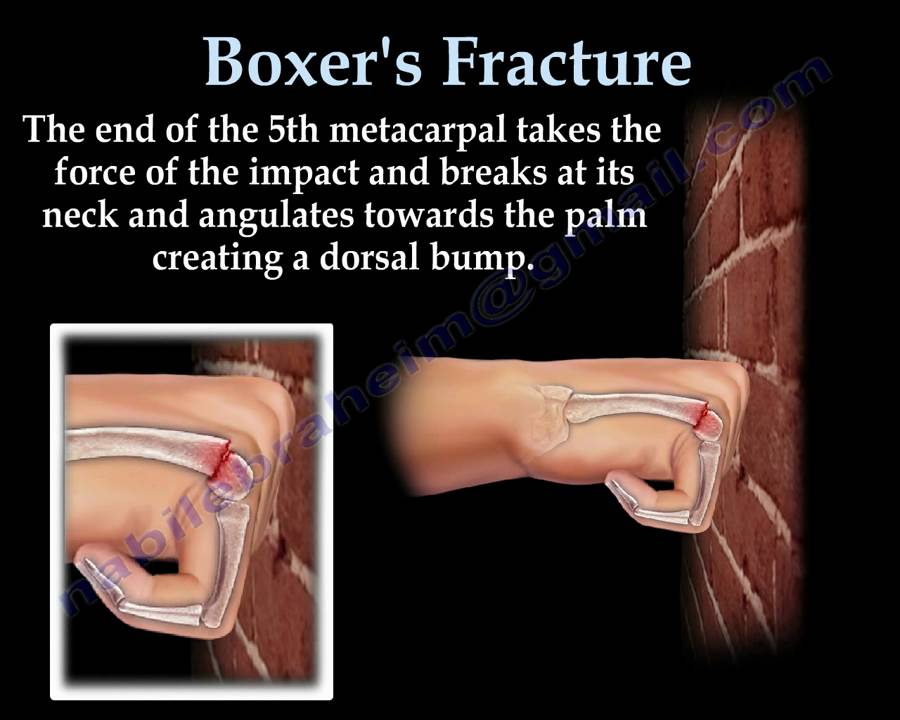 Boxer's Fracture - Everything You Need To Know - Dr. Nabil Ebraheim
