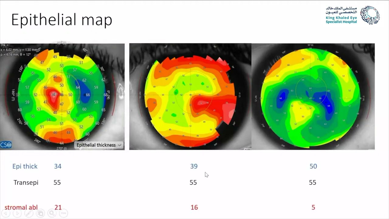 Excimer in Keratoconus: Pushing the limits or playing it safe?