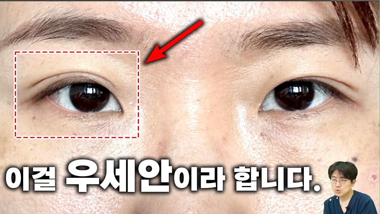 짝눈? 우세안을 아시나요?(온라인 성형 상담)