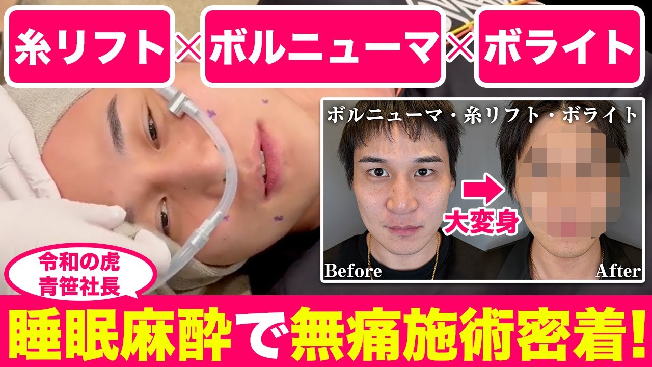 令和の虎、青笹社長を更なるイケメンに大変身！睡眠麻酔の無痛施術密着【糸リフト・ボルニューマ・ボライト】
