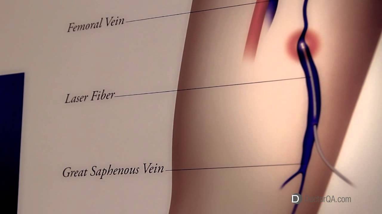 What is ambulatory phlebectomy? - Dr. Steven Deak, MD