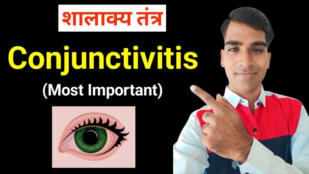Conjunctivitis In Hindi | Conjunctivitis Shalakya Tantra | Shalakya Tantra | Easy Simple Tricks 😍😍