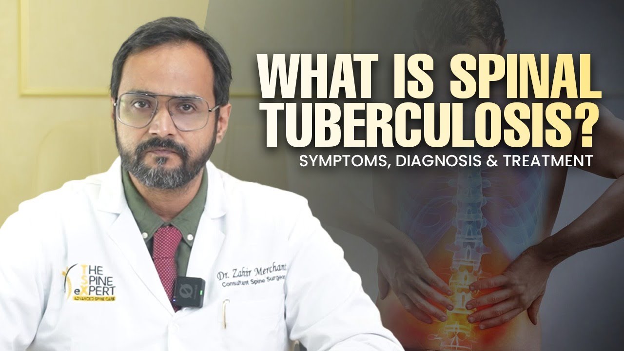 Spinal Tuberculosis (Pott&rsquo;s Disease): Symptoms, Diagnosis & Treatment | #spinedoctor #spinehealth