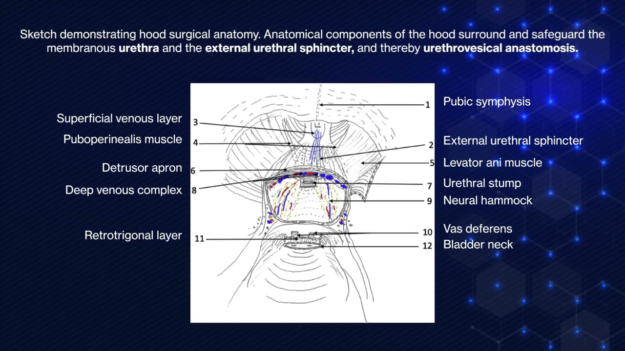 Hood Technique for Robotic Radical Prostatectomy
