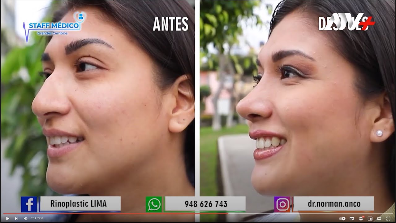 Rinoplastia híbrida ultrasónica - Dr. Norman Anco - Lima Perú (Testimonio)