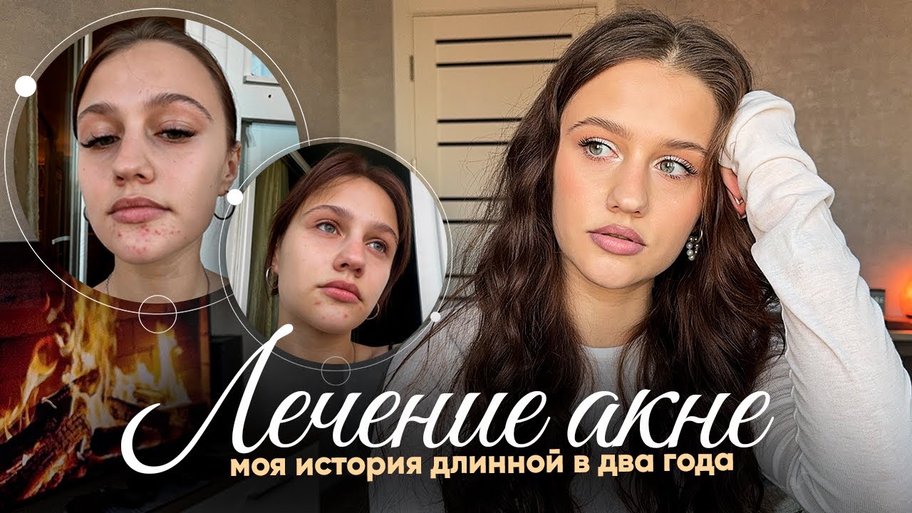МОЯ ИСТОРИЯ АКНЕ: прыщи длиною в 2 года!