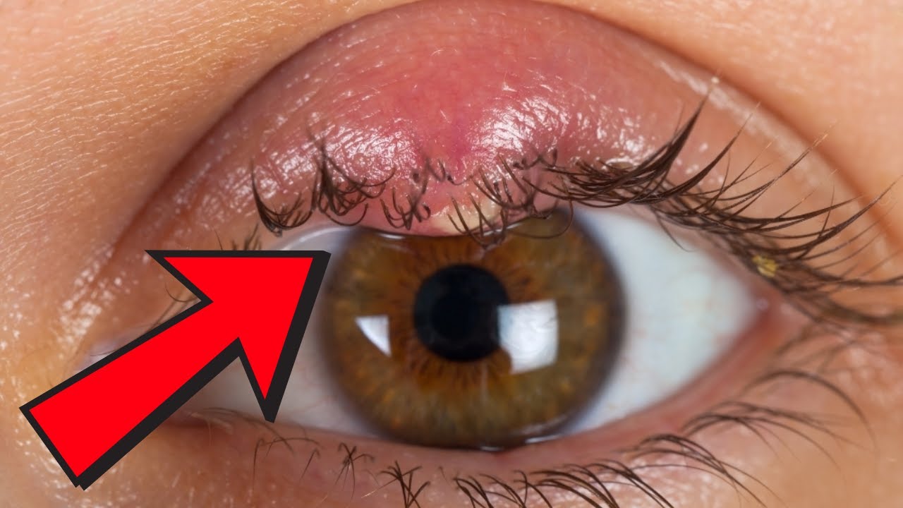 Xalazion nədir?
