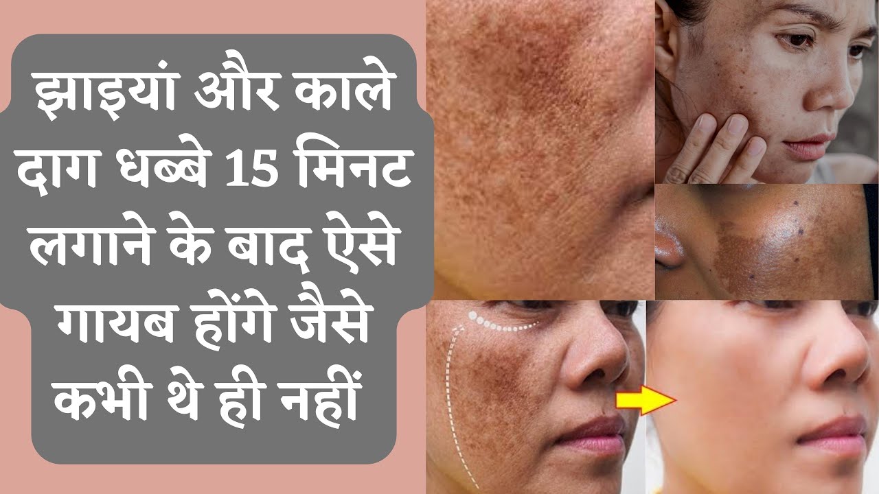 कितने भी मुश्किल झाइयाँ I Hyperpigmentation Melasma I इस Remedy से होगा 100% इलाज | DR. MANOJ DAS