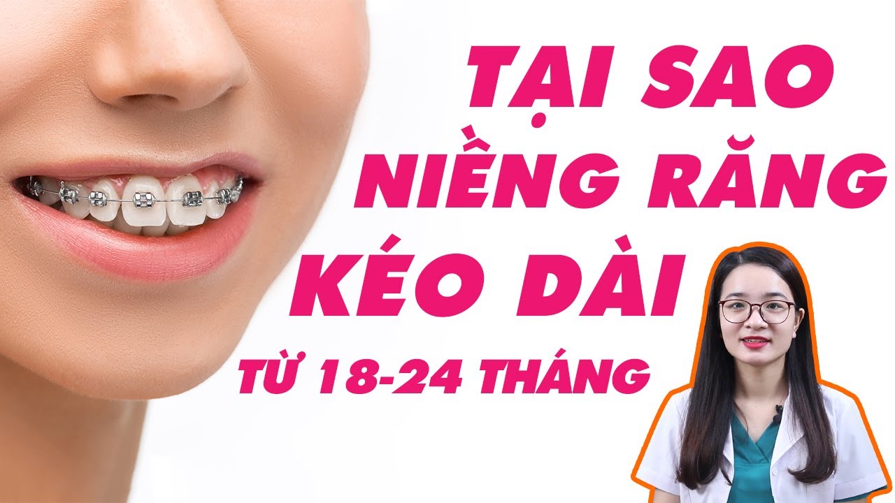 Thời gian niềng răng mất bao lâu? Chỉnh nha mất mấy năm