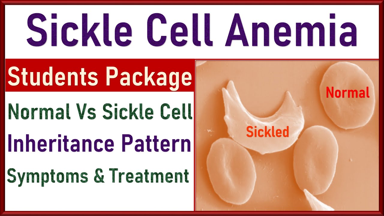 Sickle Cell Anemia - Causes, Symptoms, Treatment | Sickle Vs Normal Cell