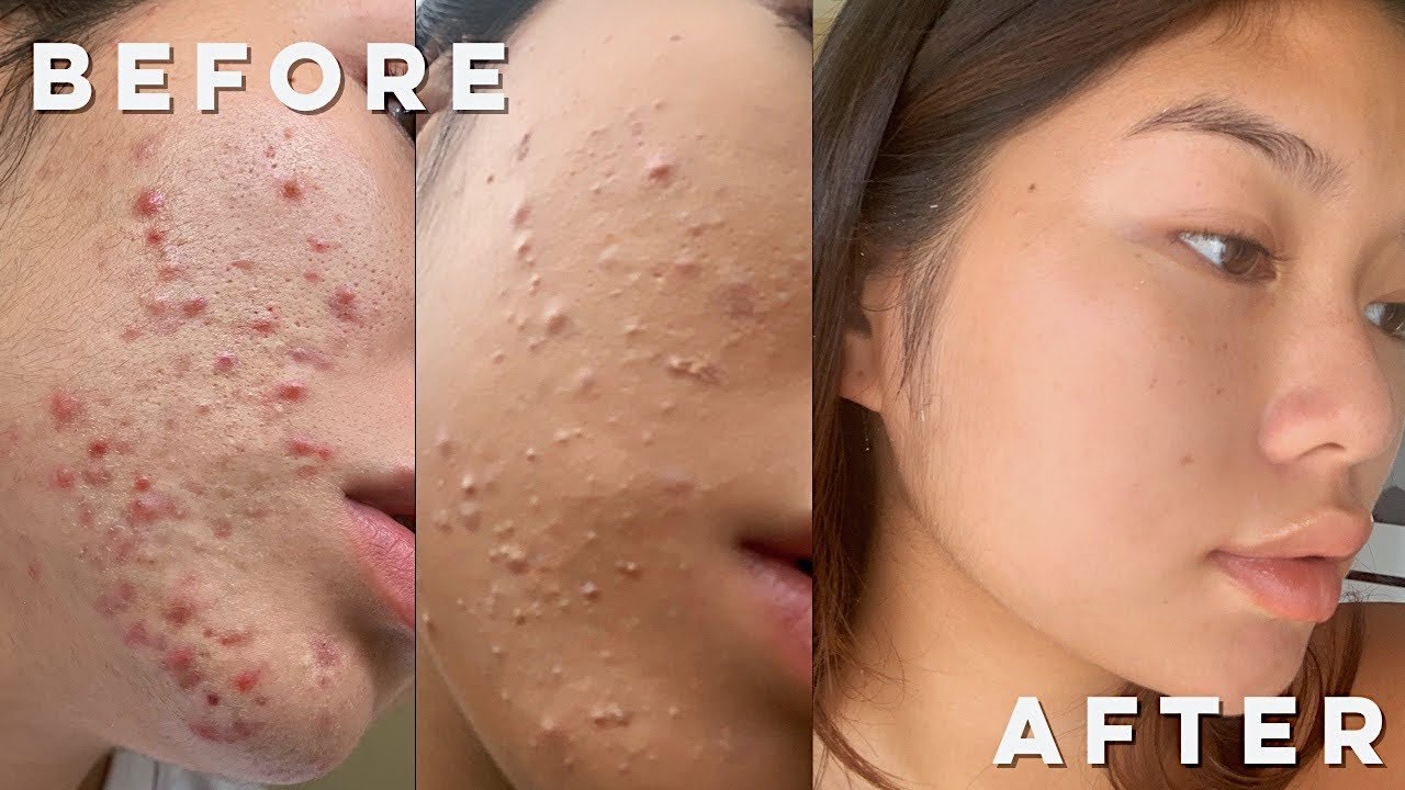 AFFORDABLE SKINCARE ROUTINE (how I cleared my skin from acne and texture!)