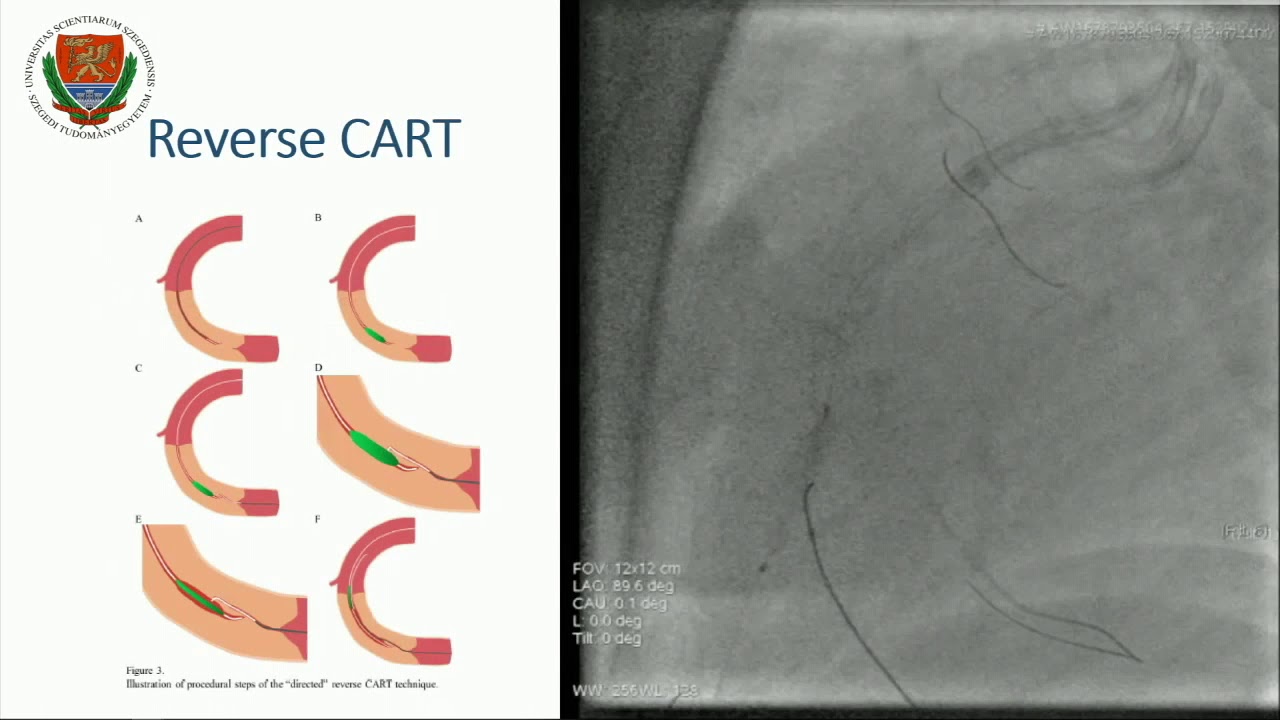 CVI 2019_Thursday, 7/18_ Coronary Challenging Case Competition _Judit Karacsonyi