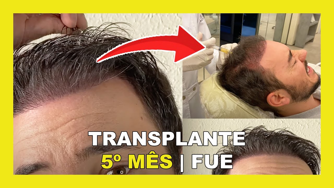 RESULTADO 5 MESES - TRANSPLANTE CAPILAR FUE - PRP CAPILAR