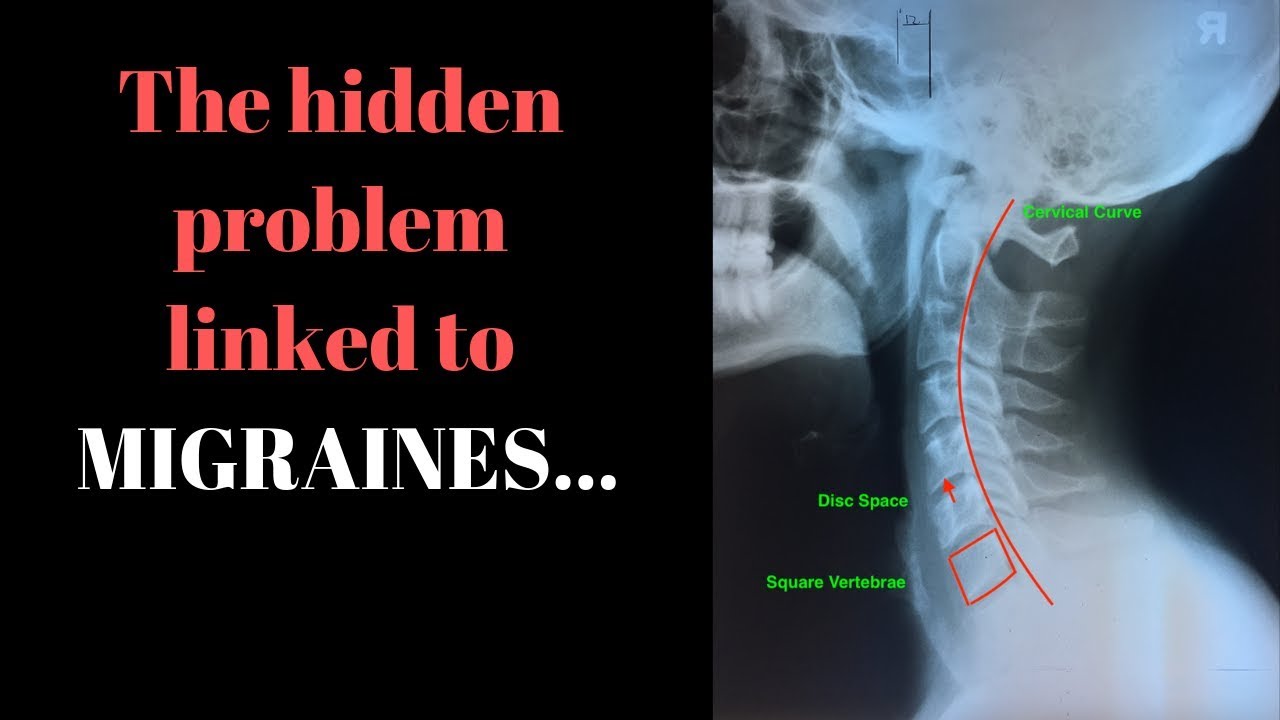 The hidden problem linked to migraines