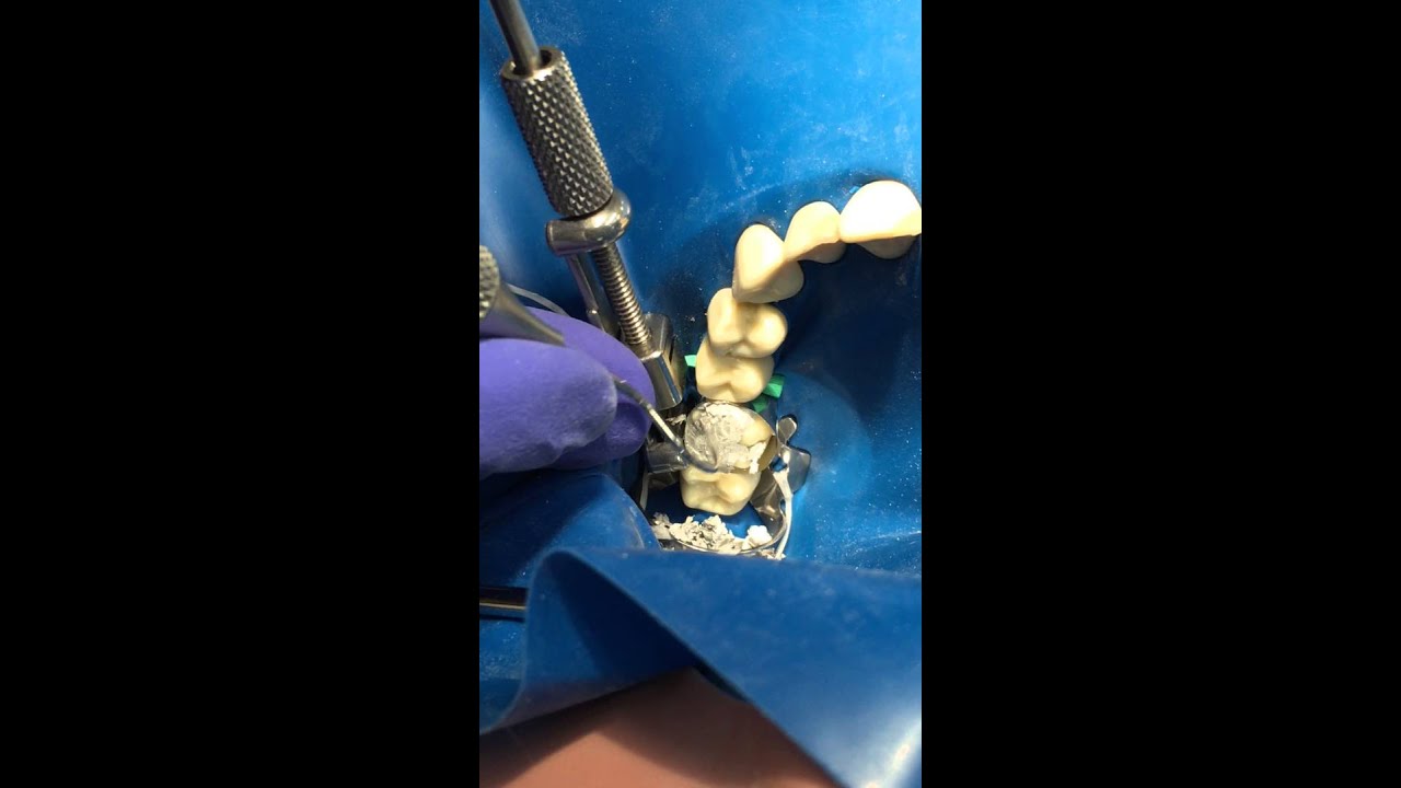 Part 2 - Amalgam Restoration MOD+ 16