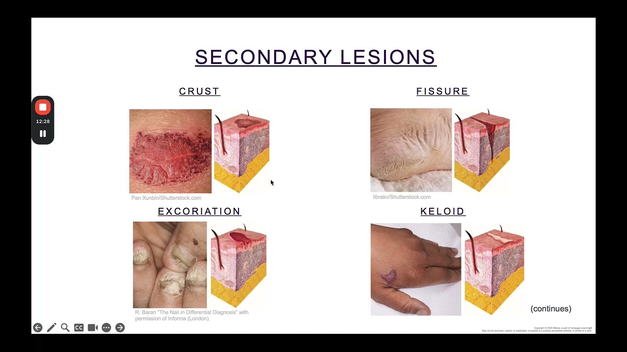 Esthetics: Ch. 4 Skin Disorders and Diseases