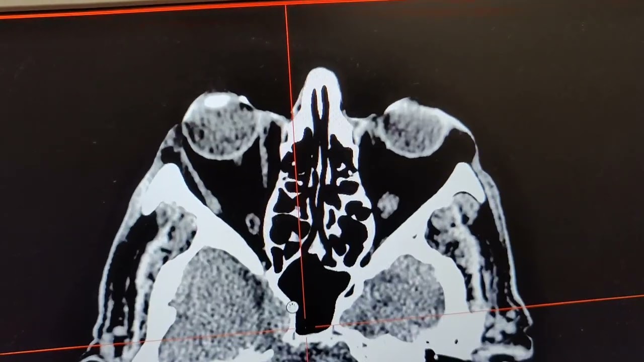Recon tips for GE, CT Head