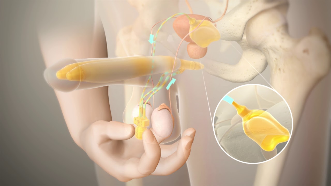 Penile Prosthesis Animation - Utah Men's Health