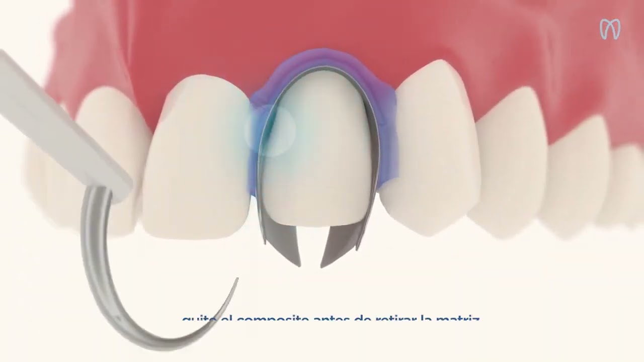 Unica anterior sistema de matrices anteriores   Polydentia