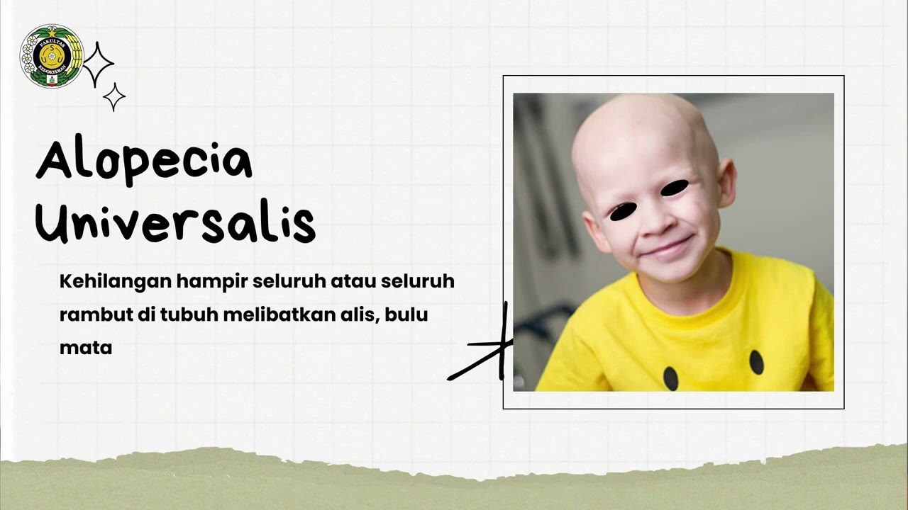 Alopecia Pada Anak