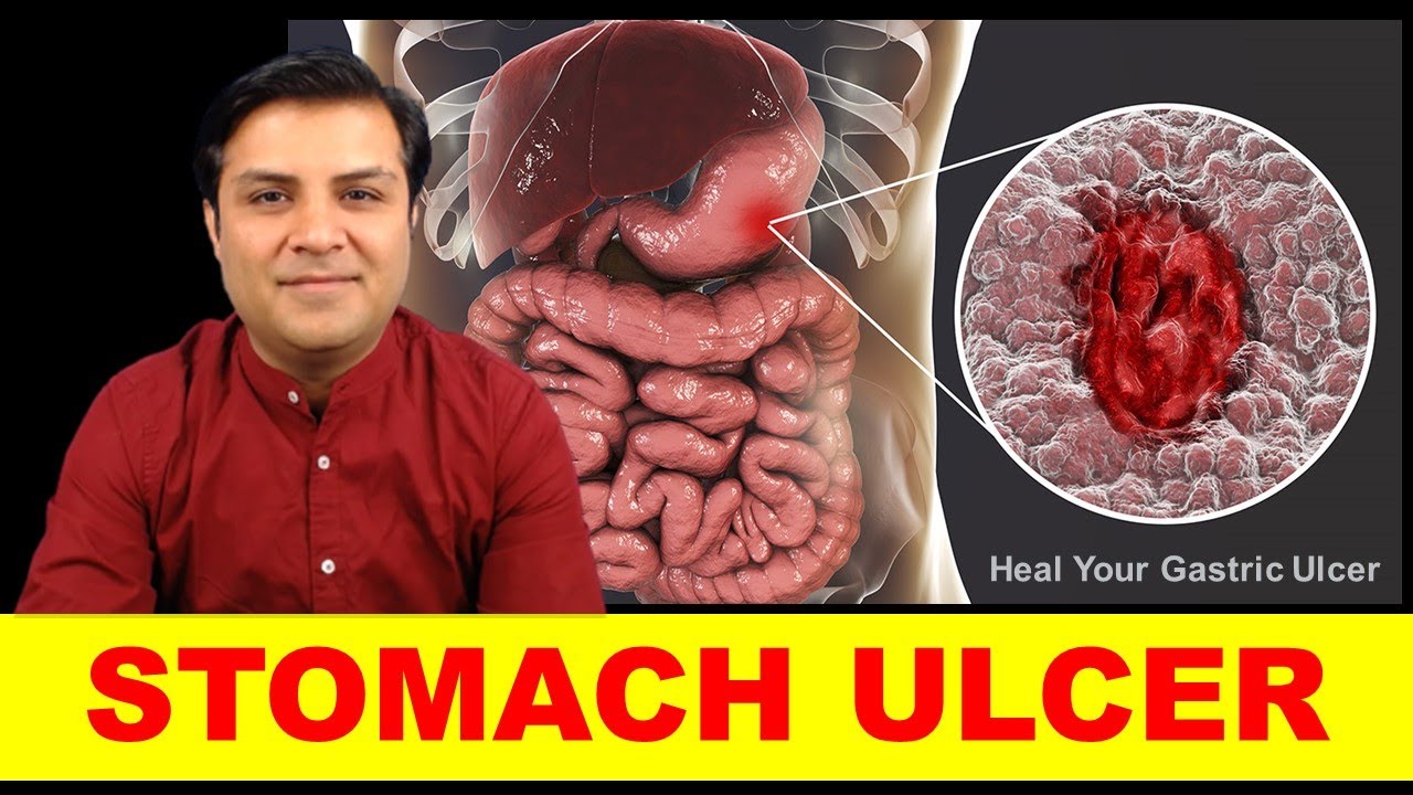 How To Get Rid Of Stomach Ulcer? – Dr. Gulab On Peptic Ulcer Natural Treatment