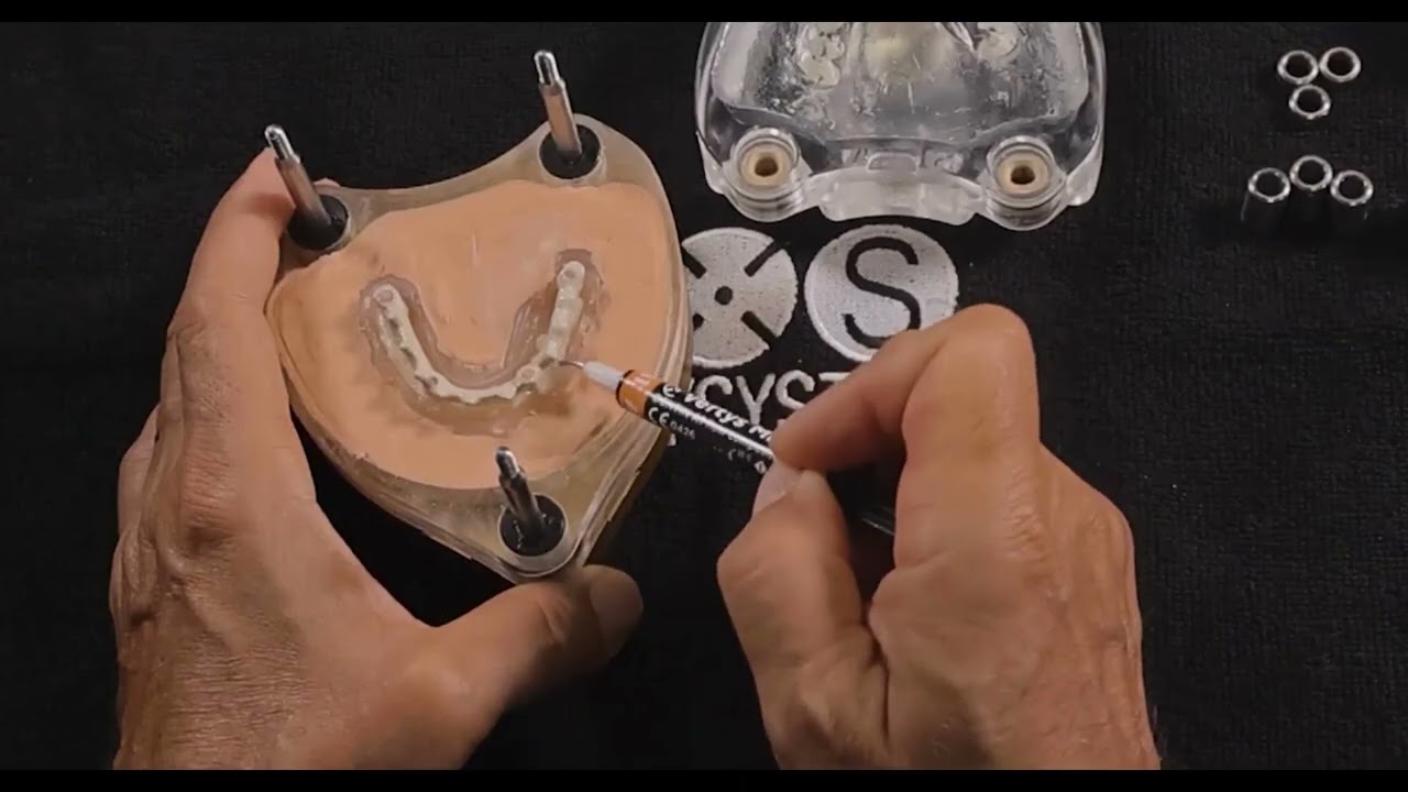 Bridge Complet sur Implants avec Vertys Mineral Quartz