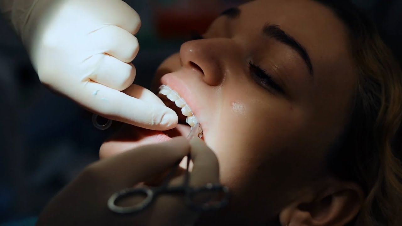 Ortodonzia con brackets in ceramica