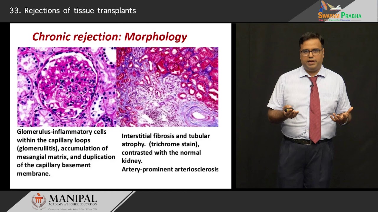 Rejections of tissue transplants