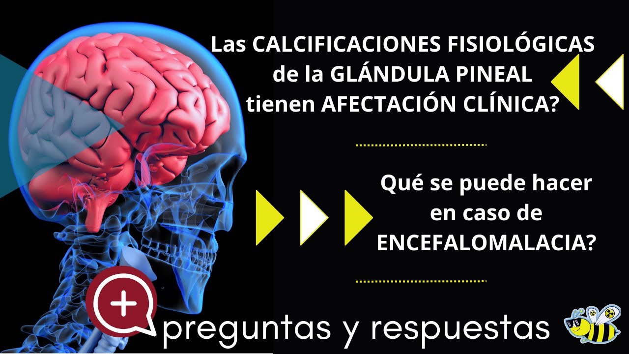 Preguntas y respuestas. Encefalomalacia, atrofia cerebral, calcificaciones cerebrales, radiación...