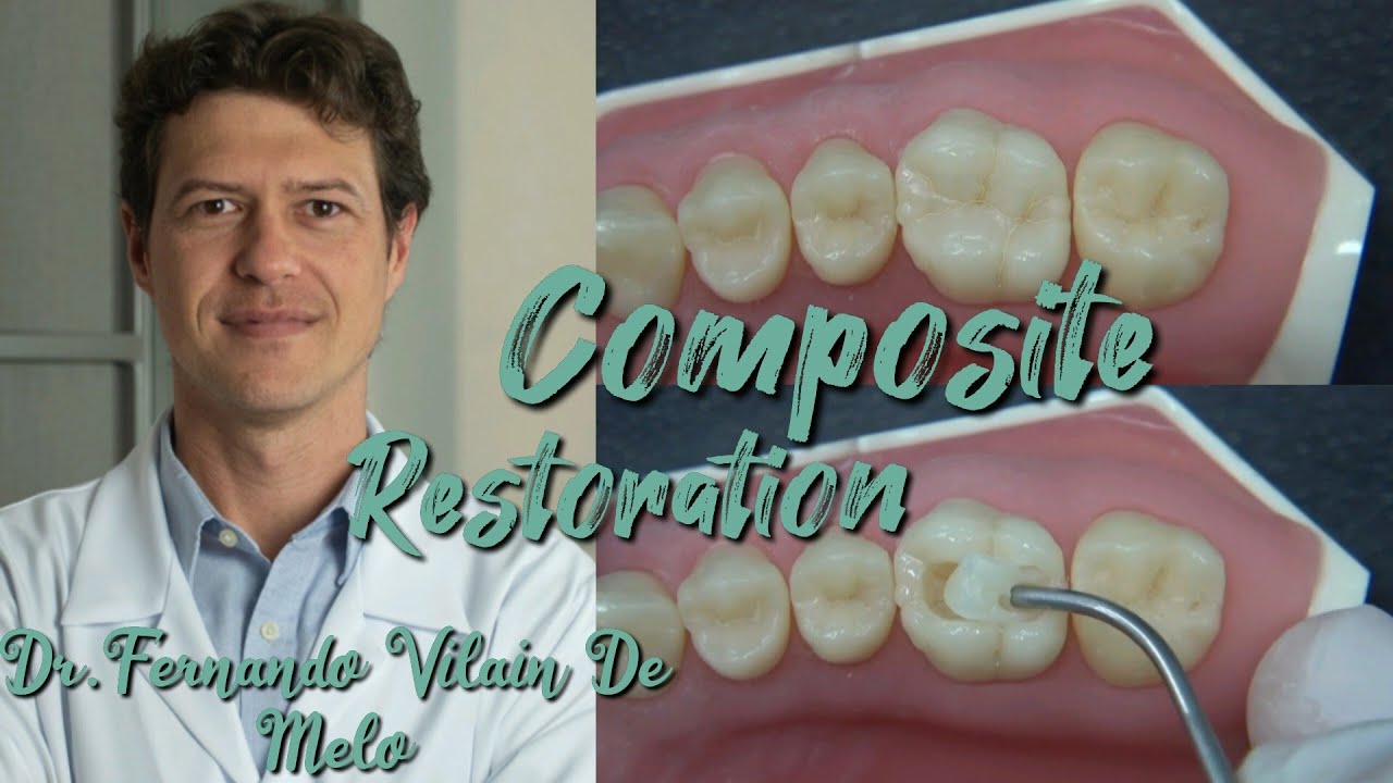 Composite restoration technique. Modeling anatomy teeth. Dr. Fernando Vilain De Melo