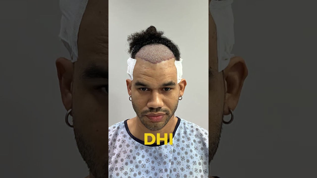 ✨ 4,799 Grafts with DHI Hair Transplant ✨