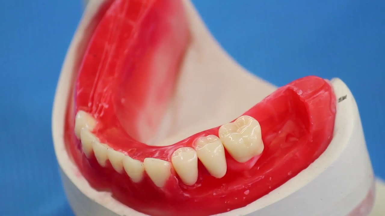 Montagem de Dentes Artificiais Posteriores