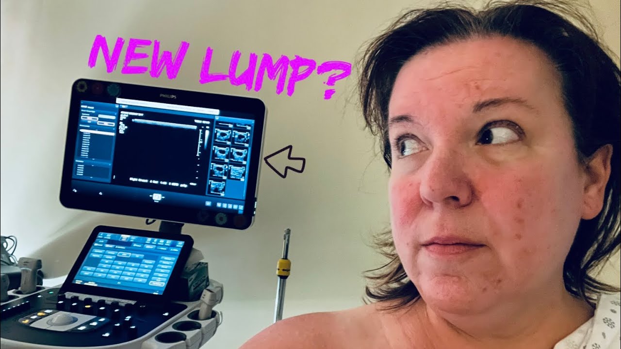 Breast Cancer - Finding a New Lump Two Years Later and Bone Scan