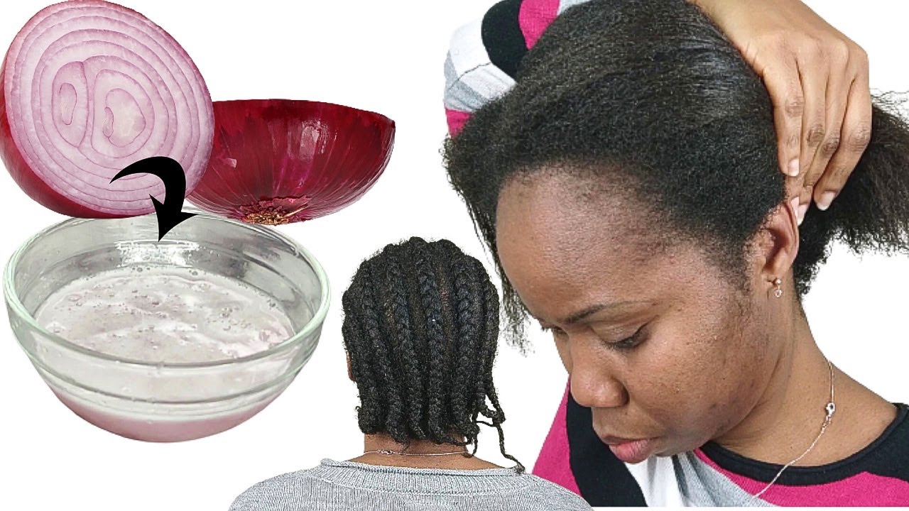 I Tried Onions Juice For 6 months on my Hair