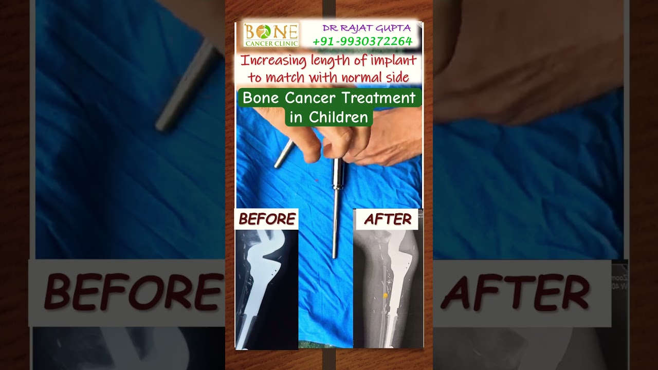 The implant that &ldquo;Grows&rdquo;😱Expandable Prosthesis - Bone Cancer Treatment in Kids- Dr Rajat Gupta