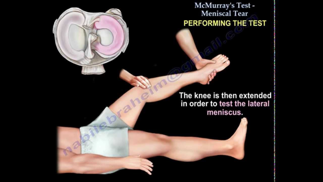 McMurray's Test - Everything You Need To Know - Dr. Nabil Ebraheim