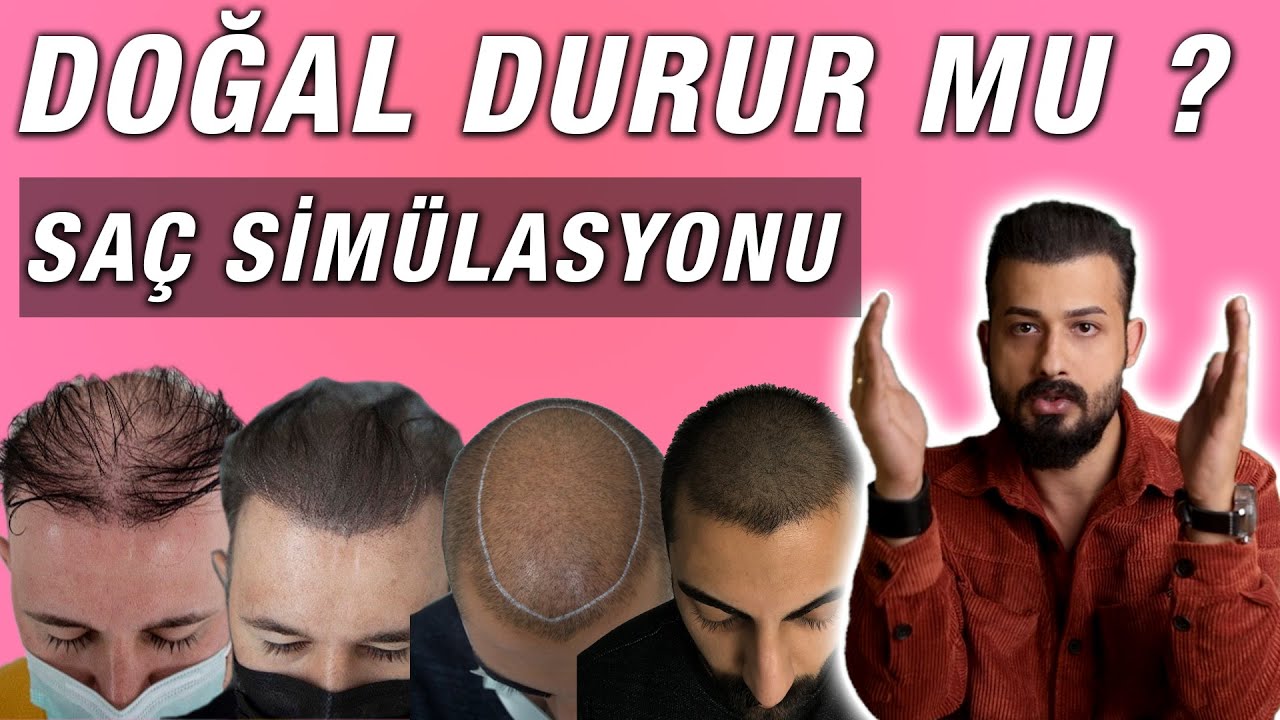 Saç Simülasyonu Doğal durur mu ? Boya gibi durur mu ? Uzm.Est.Semih DENİZ