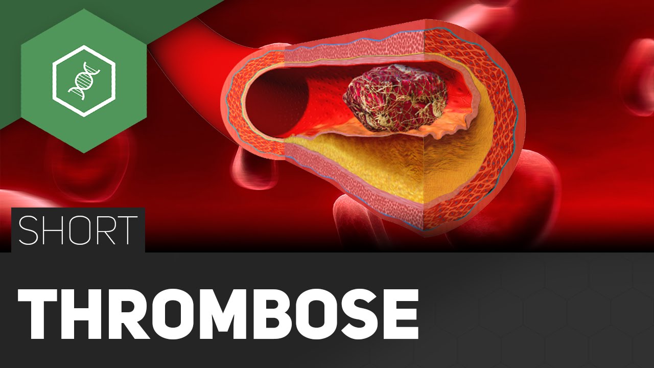 Thrombose – Rettung durch Strümpfe?!