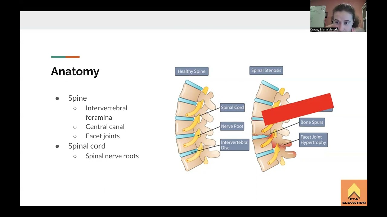 Spinal Stenosis - NPTE Prep